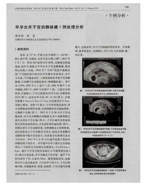 早孕合并子宫动静脉瘘1例处理分析