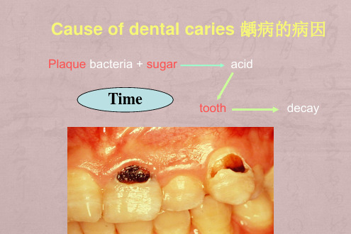 氟化物与牙健康