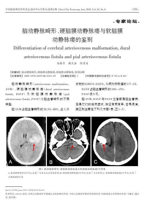脑动静脉畸形、硬脑膜动静脉瘘与软脑膜动静脉瘘的鉴别