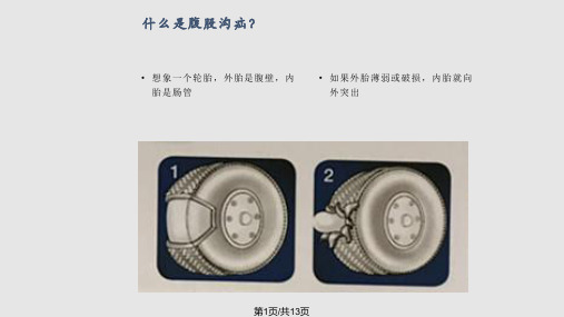 腹股沟疝病人健康教育PPT课件