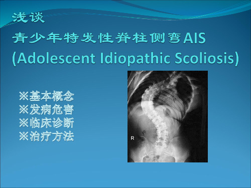 青少年特发性脊柱侧弯 AIS-文档资料