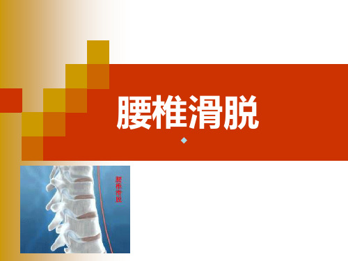 腰椎滑脱_课件