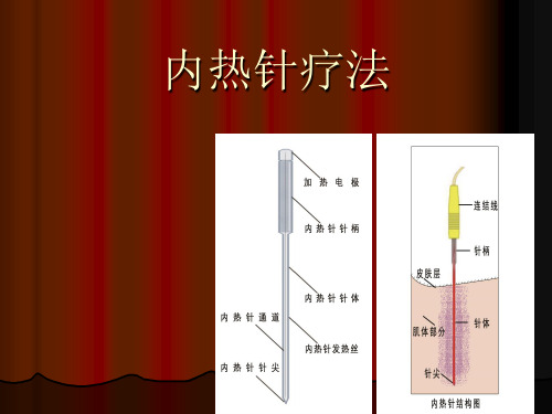 内热针疗法精品课件
