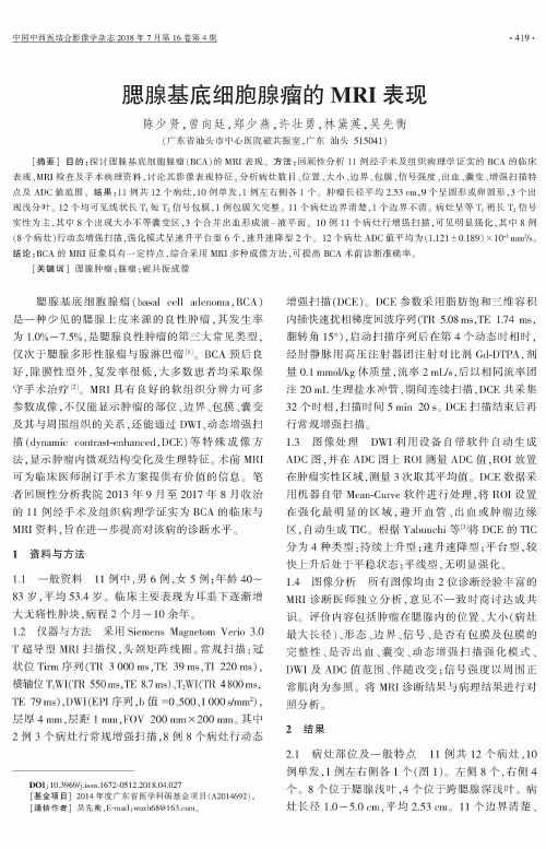 腮腺基底细胞腺瘤的MRI表现