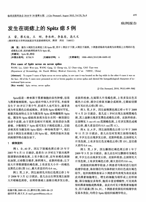 发生在斑痣上的Spitz痣5例