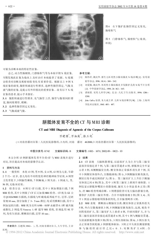 胼胝体发育不全的CT与MRI诊断