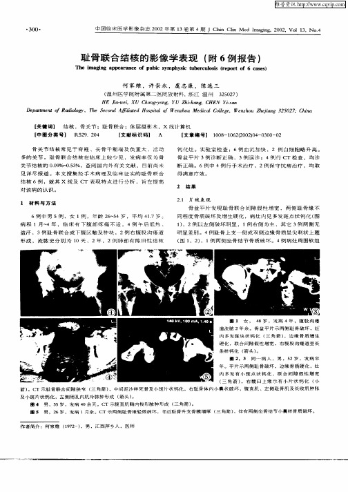 耻骨联合结核的影像学表现(附6例报告)