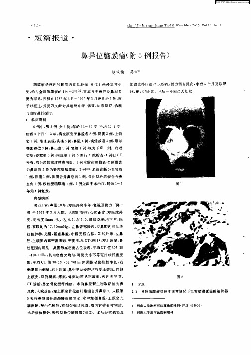 鼻异位脑膜瘤(附5例报告)