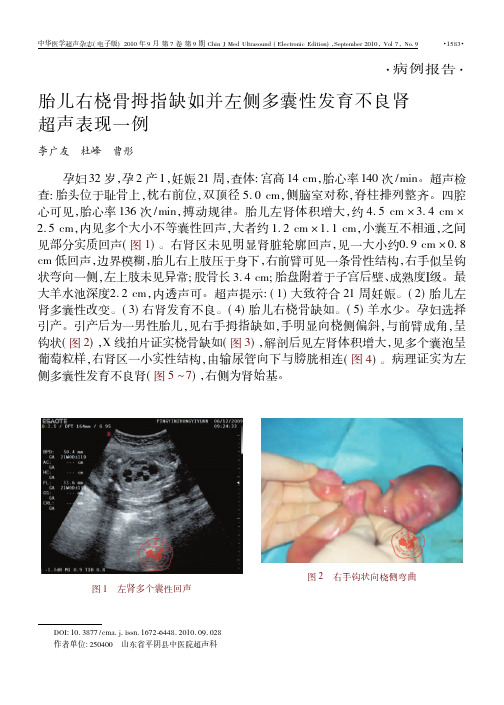 胎儿右桡骨拇指缺如并左侧多囊性发育不良肾超声表现一例