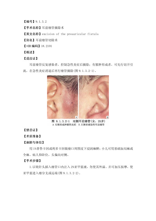 耳前瘘管摘除术 