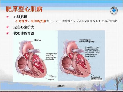 肥厚性心肌病解读  ppt课件