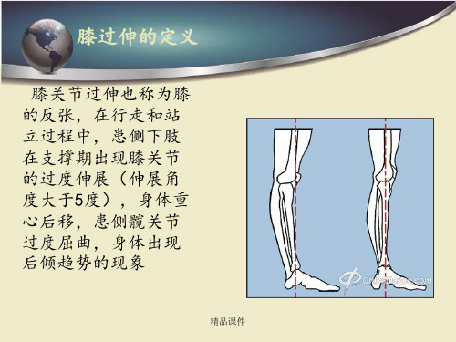 膝过伸的原因和训练方法