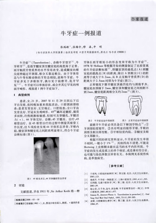 牛牙症一例报道