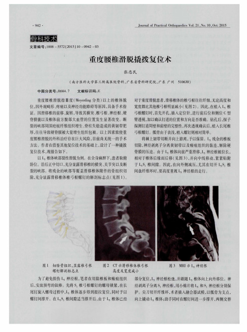 重度腰椎滑脱撬拨复位术