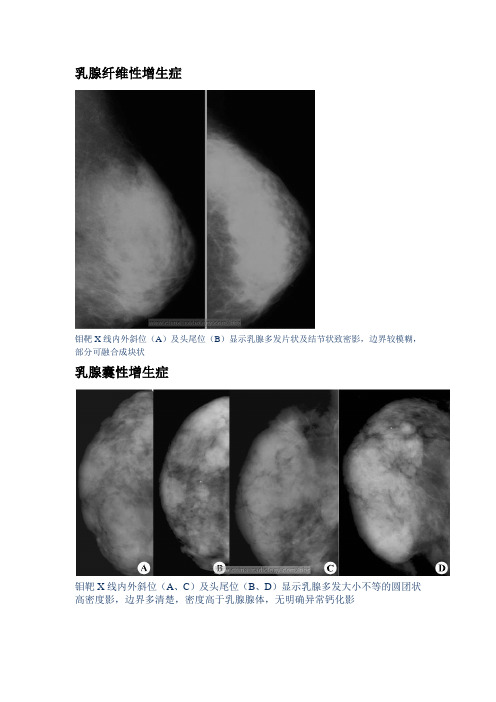 乳腺钼靶影像诊断