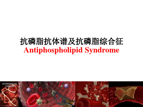 抗磷脂综合征PPT