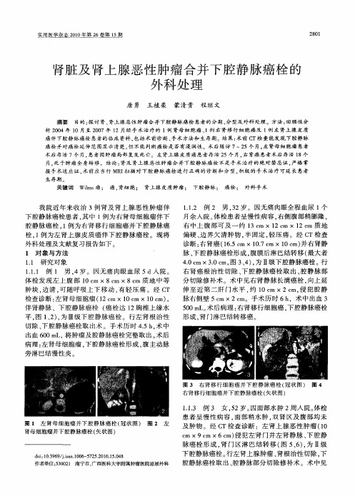 肾脏及肾上腺恶性肿瘤合并下腔静脉癌栓的外科处理
