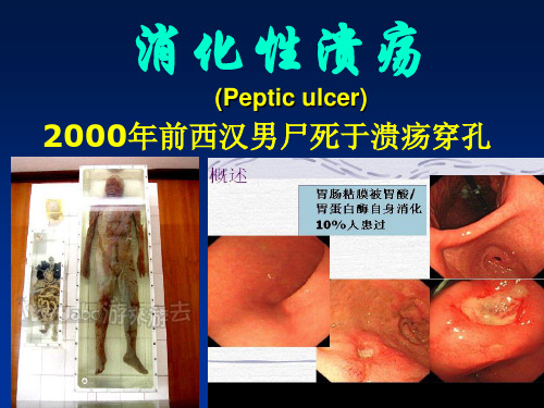 消化性溃疡