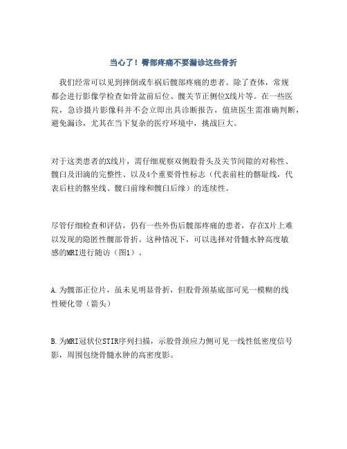 当心了!臀部疼痛不要漏诊这些骨折