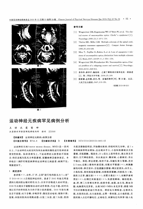 运动神经元疾病罕见病例分析