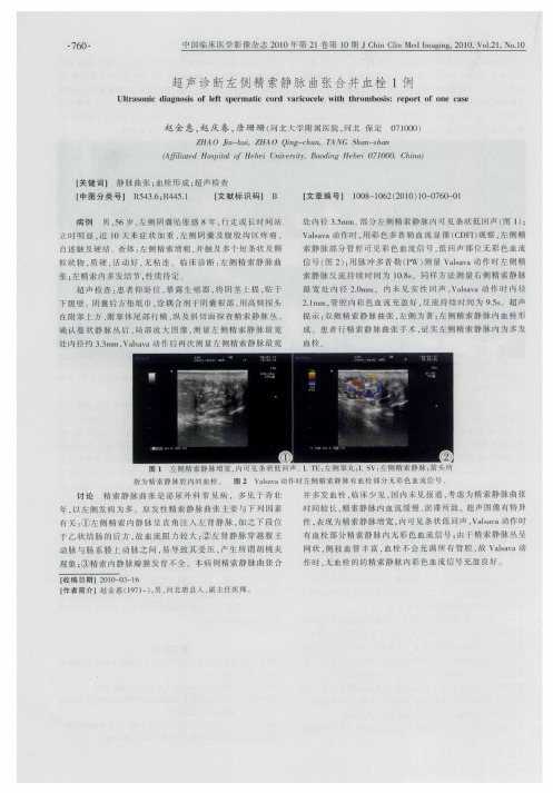 超声诊断左侧精索静脉曲张合并血栓1例