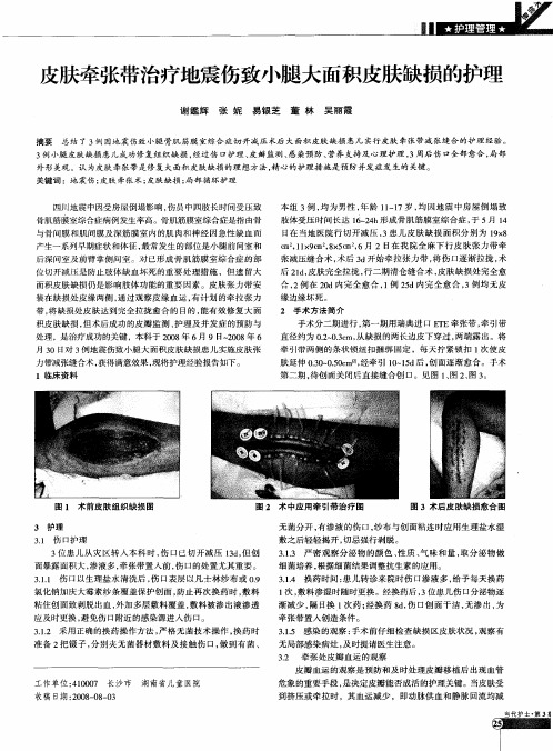 皮肤牵张带治疗地震伤致小腿大面积皮肤缺损的护理