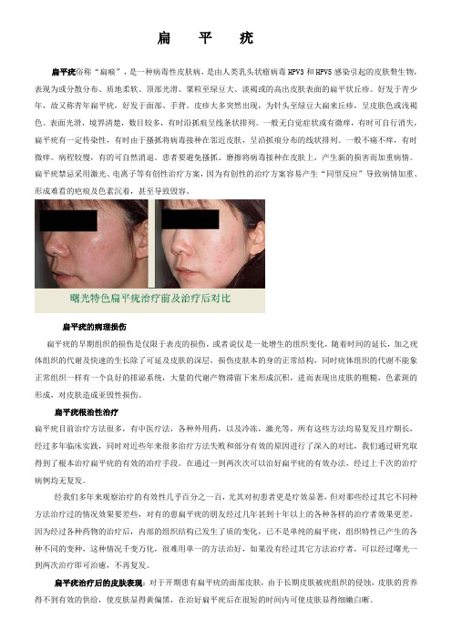 扁    平    疣