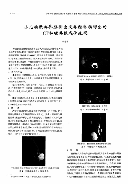 小儿腰骶部脊膜膨出及脊髓脊膜膨出的CT和磁共振成像表现