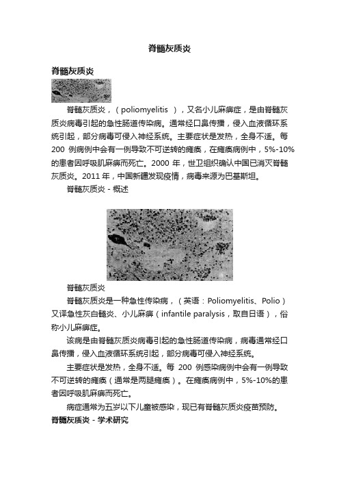 脊髓灰质炎