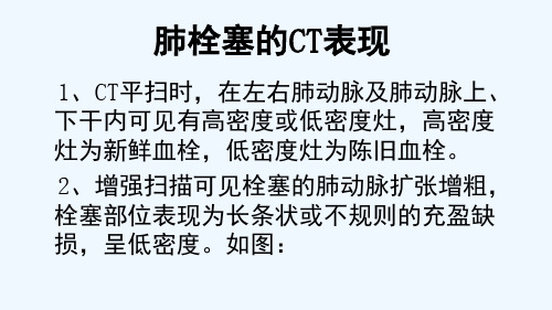 肺栓塞ct增强的解析