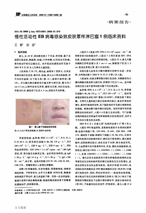 慢性活动性EB病毒感染致皮肤蕈样淋巴瘤1例临床资料