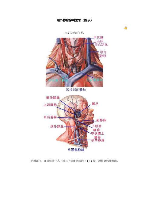 颈外静脉穿刺置管