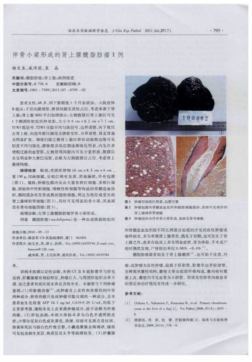 伴骨小梁形成的肾上腺髓脂肪瘤1例