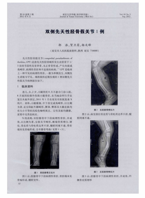 双侧先天性胫骨假关节1例