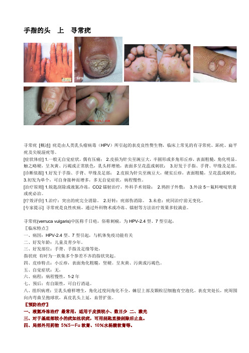 手指的头  上  寻常疣