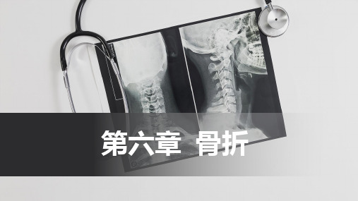 骨折-骨折概述(中医骨伤科学十三五教材)