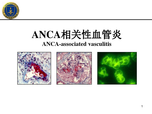 ANCA相关性血管炎PPT课件