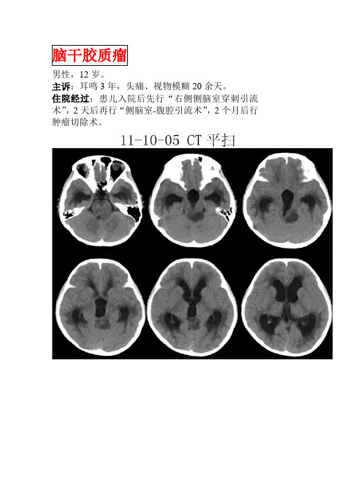 1.1脑干胶质瘤