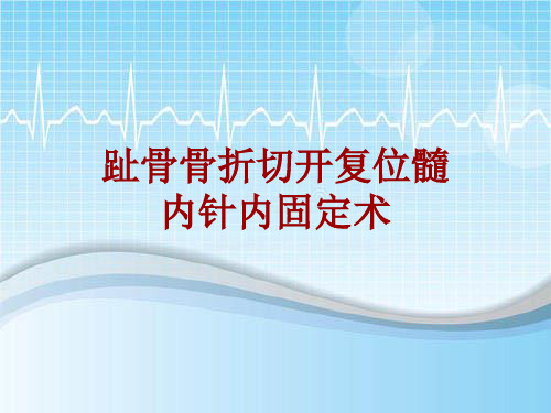 手术讲解模板：趾骨骨折切开复位髓内针内固定术