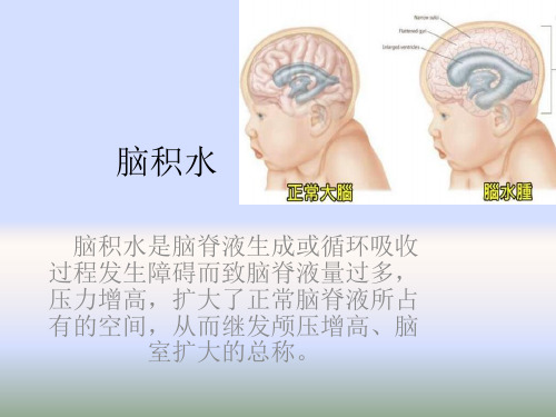 脑积水PPT