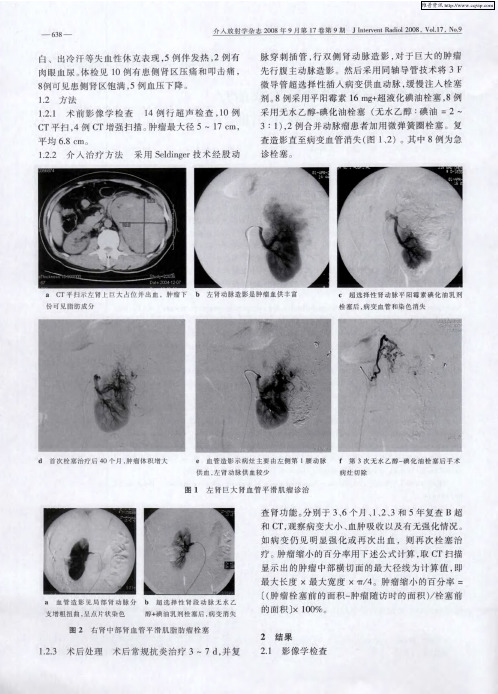 超选择性节段性肾动脉栓塞治疗肾血管平滑肌脂肪瘤破裂出血