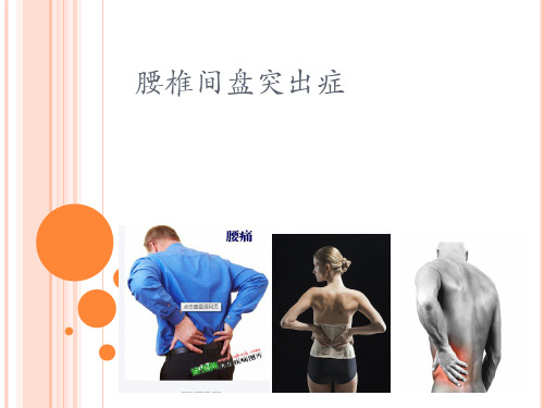 腰椎间盘突出症