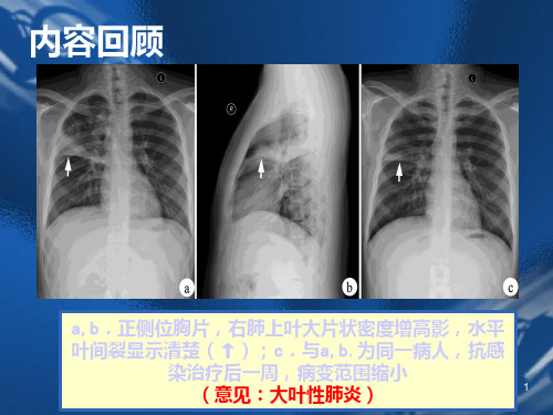 医学影像诊断学-呼吸系统-PPT课件