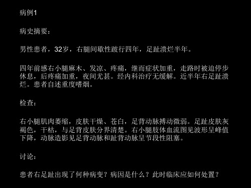 血栓闭塞性脉管炎