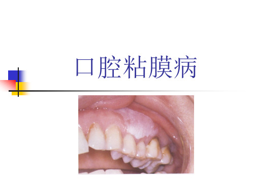 口腔粘膜病