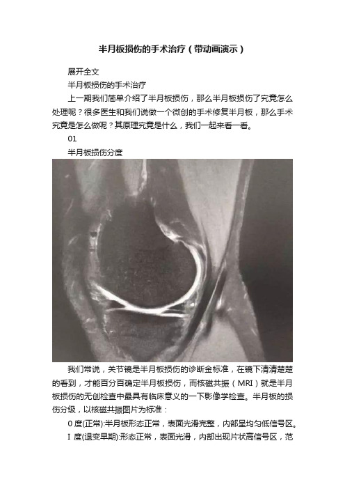 半月板损伤的手术治疗（带动画演示）