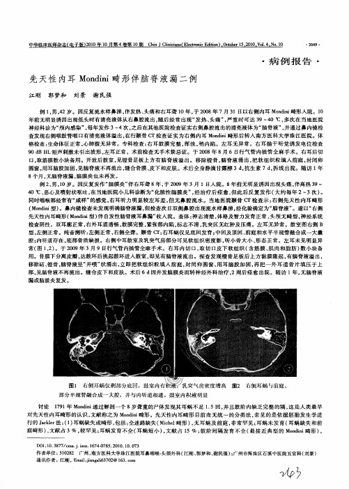 先天性内耳Mondini畸形伴脑脊液漏二例
