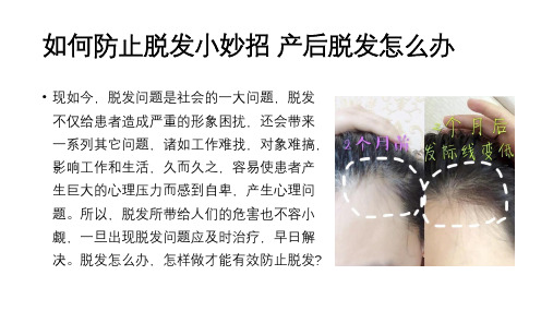 如何防止脱发小妙招 产后脱发怎么办