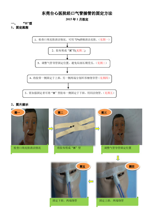 经口气管插管的固定方法