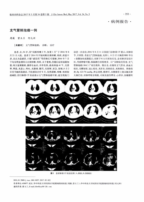 支气管肺泡癌一例